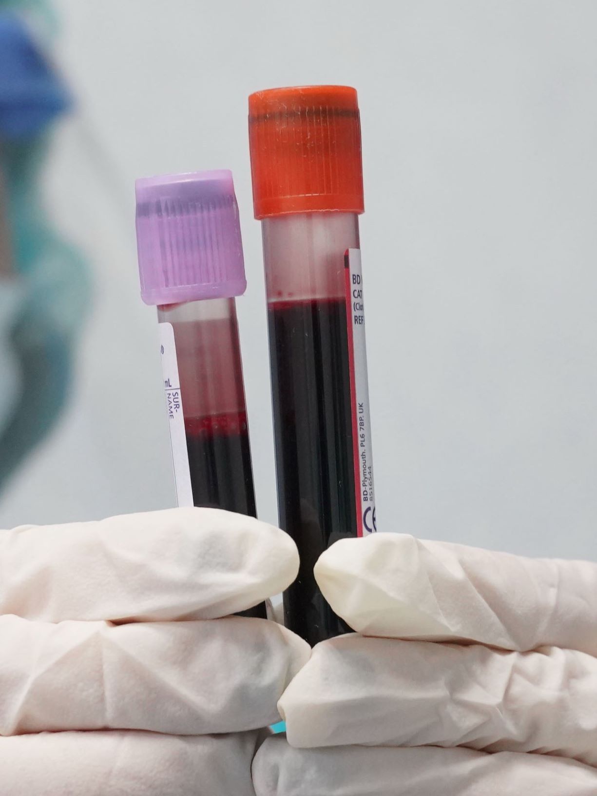 Analisi del sangue per individuare più precocemente i tumori, parte in Usa una maxi sperimentazione